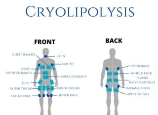 Cryolipo